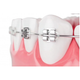 Adesivo Colagem de Braquete Ortodontia