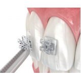 Adesivo Ortodôntico Biofix Biodinâmica