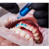 Adesivo Ortodôntico Orthocem Fgm