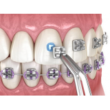 Adesivo Ortodôntico Orthocem Uv Trace