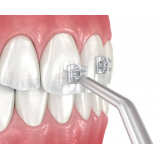 Adesivo para Colagem Braquetes Fgm