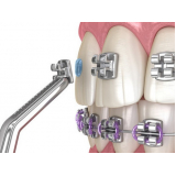 Adesivo para Colagem de Braquetes