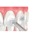 adesivos para colagem de braquetes Chora Menino adesivos para colagem de braquetes Chora Menino