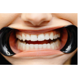 Afastador e Abridor de Boca Indusbelo Black