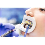 Afastador Labial Ortodôntico em V