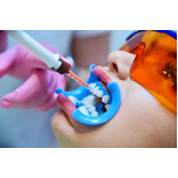 Afastador Labial para Fotografia Frontal Lateral