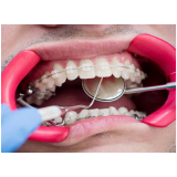 Afastador Labial para Fotografia