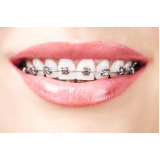 Arcos Cooper Niti Ortodontia