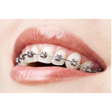 Arcos Niti Ortodontia