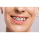 Arcos Niti para Ortodontia