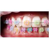 Arcos Termo Ativado Ortodônticos