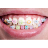 Sequencia Arcos Niti Orthometric