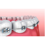 braquete autoligado estético Campinas