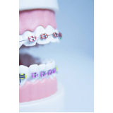 braquete polysafira morelli valor Vila Albertina