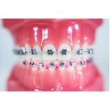 braquete porcelana preço Santo Antônio Paulista