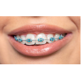 braquete porcelana valor Piracicaba