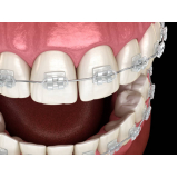 braquete safira Jockey Club