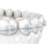 braquetes autoligado easyclip+ valor Jardim Marajoara