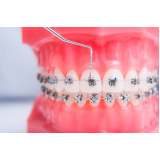 braquetes orthometric preço Tanquinho