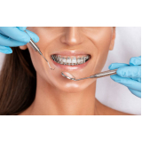 dental ortodontia de produtos morelli valor Caraguatatuba dental ortodontia de produtos morelli valor Caraguatatuba