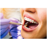 dental ortodontia entrega imediata preço Piracicaba dental ortodontia entrega imediata preço Piracicaba