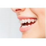 dental ortodontia produtos aditek valor Vila Formosa dental ortodontia produtos aditek valor Vila Formosa