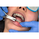dental ortodontia produtos orthomertric valor Presidente Prudente dental ortodontia produtos orthomertric valor Presidente Prudente
