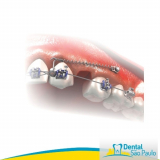 mini implante extra alveolar Água Branca mini implante extra alveolar Água Branca