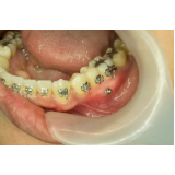 Mini Parafuso Ortodôntico Morelli Comprimento 10 Mm