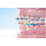 Mini Parafuso Ortodôntico Morelli Comprimento 6 Mm