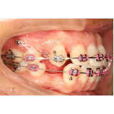 Mini Parafuso Ortodôntico Morelli Comprimento 8 Mm