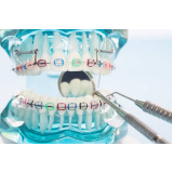 Mini Parafuso Ortodôntico para Ancoragem Absoluta Morelli