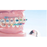 Mini Parafuso para Aparelho Ortodôntico