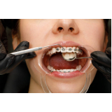onde encontrar dental orto Freguesia do Ó onde encontrar dental orto Freguesia do Ó
