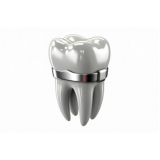 onde encontro banda ortodôntica para pre molar Ubatuba onde encontro banda ortodôntica para pre molar Ubatuba
