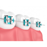 onde encontro braquete autoligado estético Diadema