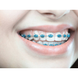 onde encontro braquete autoligado morelli Litoral