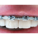 onde encontro braquete safira Bixiga