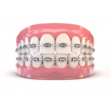 onde encontro braquetes autoligado easyclip+ Rio Claro