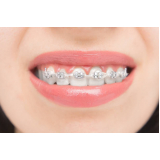 onde encontro braquetes morelli Itapecerica da Serra