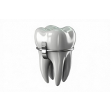 procuro banda ortodôntica para pre molar Campo Grande procuro banda ortodôntica para pre molar Campo Grande