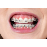 procuro braquetes autoligado easyclip+ ARUJÁ