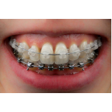 procuro braquetes autoligados Vargem Grande Paulista