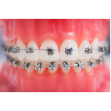 procuro braquetes orthometric Santa Efigênia