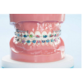 procuro mini parafuso ortodôntico morelli comprimento 6 mm Caieiras procuro mini parafuso ortodôntico morelli comprimento 6 mm Caieiras