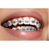 Arcos Niti Arcos Niti