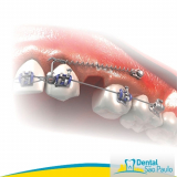 Mini Implantes Mini Implantes