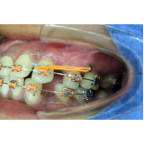 Mini Parafusos Ortodônticos Mini Parafusos Ortodônticos