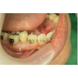 quanto custa mini parafuso ortodôntico morelli comprimento 10 mm Jaraguá quanto custa mini parafuso ortodôntico morelli comprimento 10 mm Jaraguá